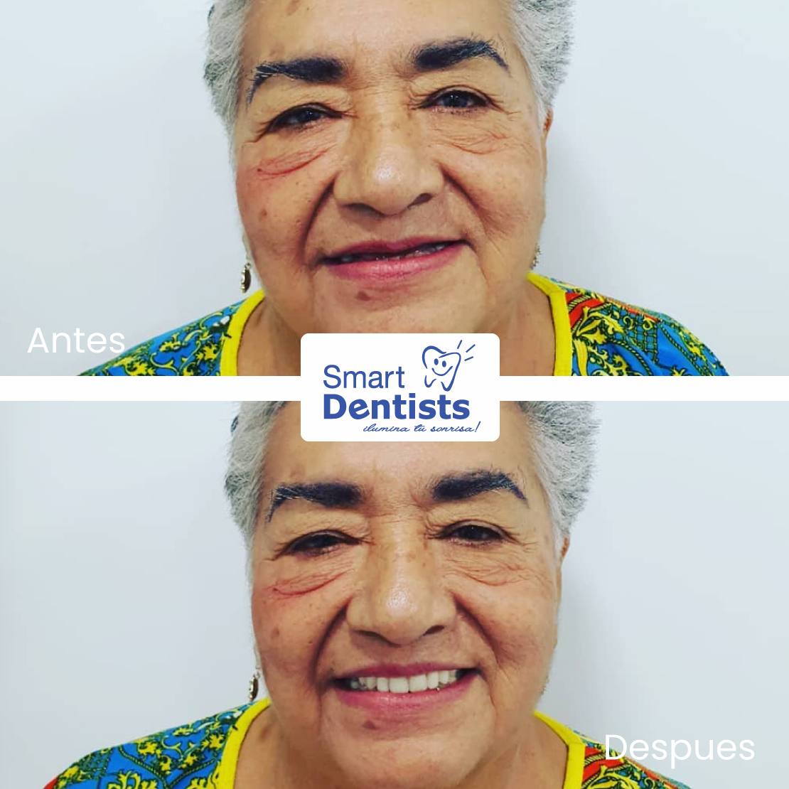 PROTESIS DENTAL 👌🏼⠀𝑽𝒖𝒆𝒍𝒗𝒆 𝒂 𝑺𝒐𝒏𝒓𝒆𝒊𝒓 𝑺𝒊𝒏 𝑪𝒐𝒎𝒑𝒍𝒆𝒋𝒐𝒔