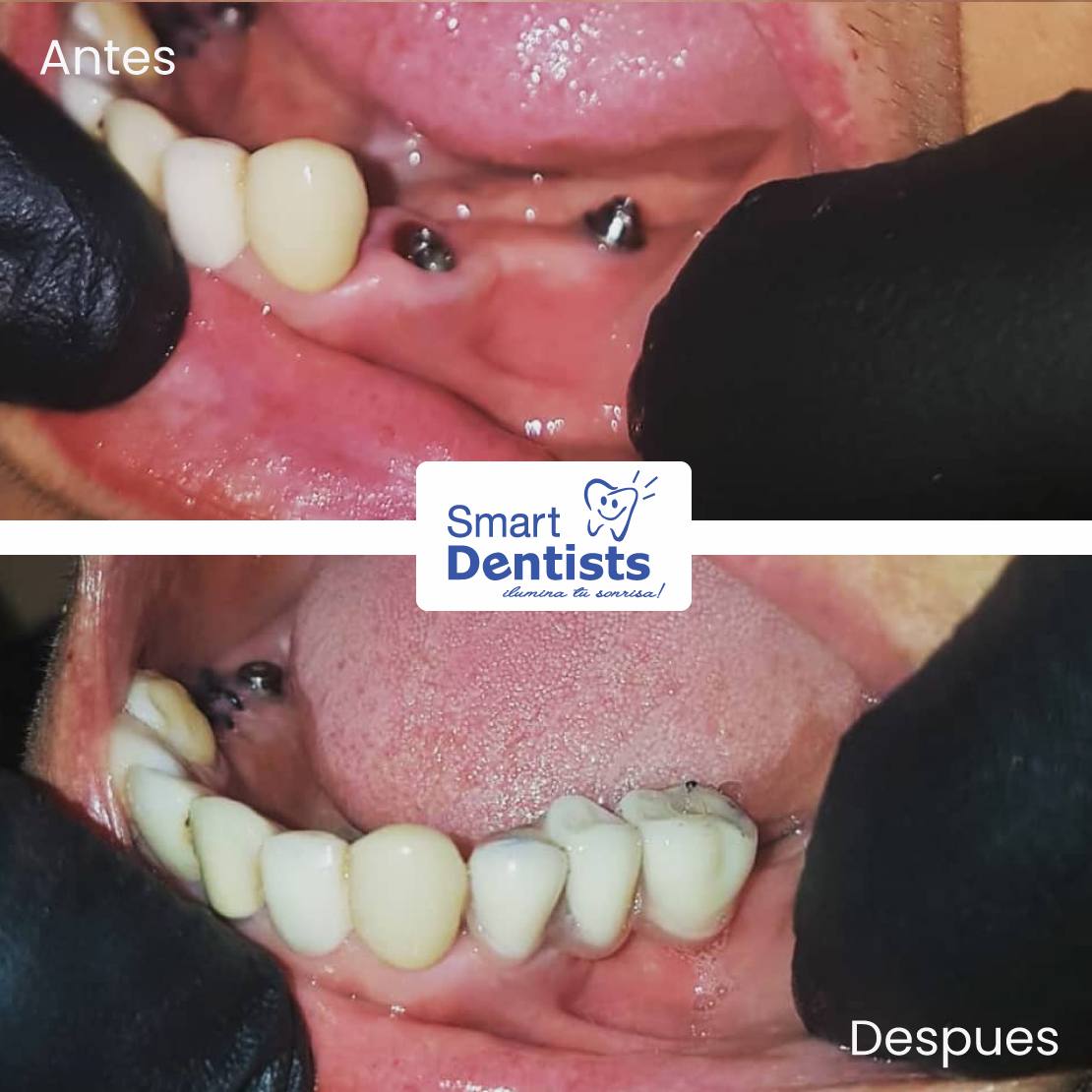 PROTESIS DENTAL 👌🏼⠀𝑽𝒖𝒆𝒍𝒗𝒆 𝒂 𝑺𝒐𝒏𝒓𝒆𝒊𝒓 𝑺𝒊𝒏 𝑪𝒐𝒎𝒑𝒍𝒆𝒋𝒐𝒔