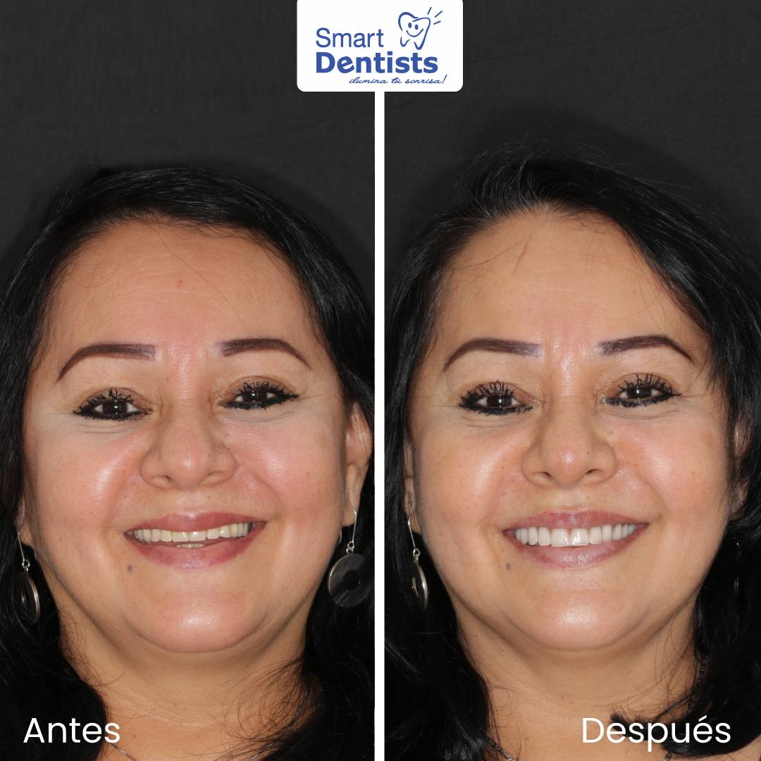 IMPLANTES DENTALES 👌🏼⠀𝑽𝒖𝒆𝒍𝒗𝒆 𝒂 𝑺𝒐𝒏𝒓𝒆𝒊𝒓 𝑺𝒊𝒏 𝑪𝒐𝒎𝒑𝒍𝒆𝒋𝒐𝒔