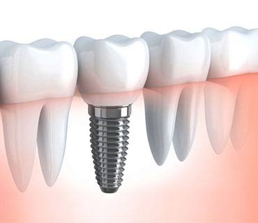 Implantes Dentales